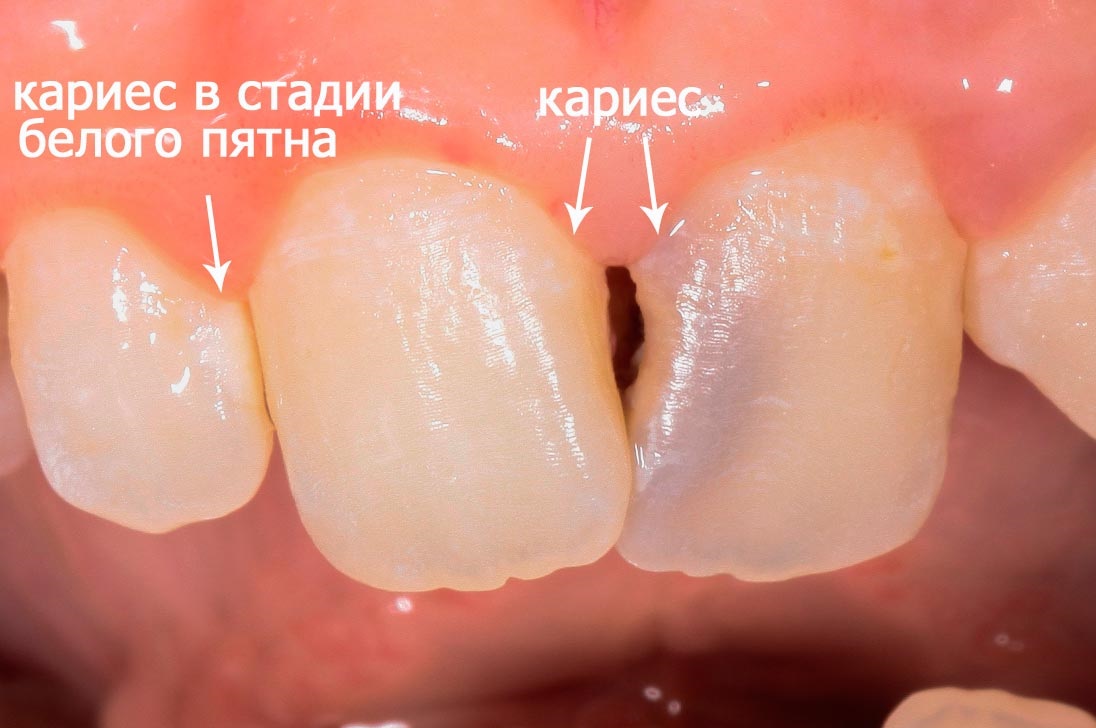 Karies-perednih-zubov